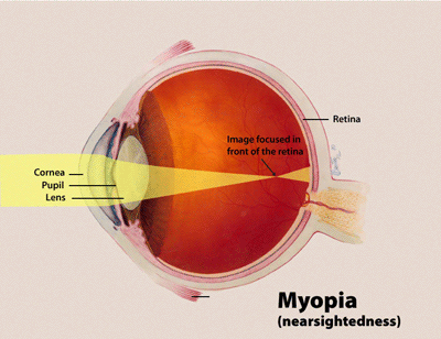 control myopia