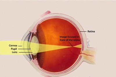 Keratoconus 