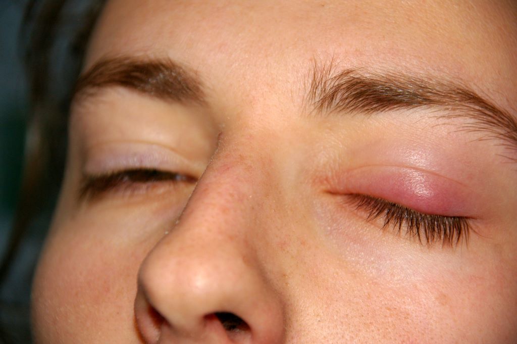 Chalazion1