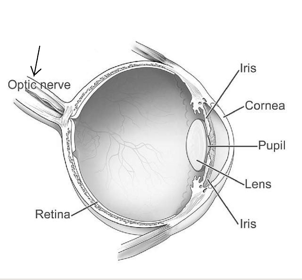 glaucoma