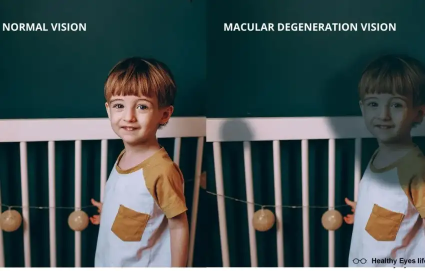 MACULAR DEGENERATION