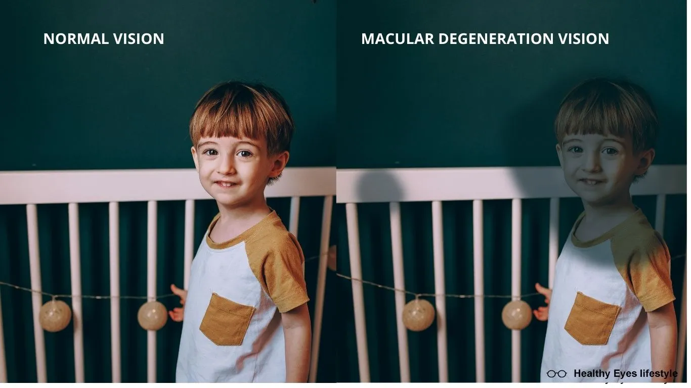 MACULAR DEGENERATION